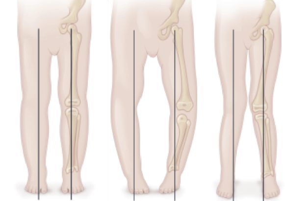 寶寶有o型腿/x型腿,是缺鈣嗎?需要矯正嗎?3種情況別大意!