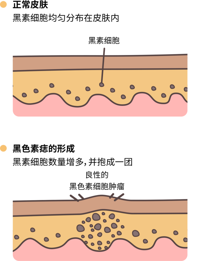 痣也可能会癌变长在3个地方要注意