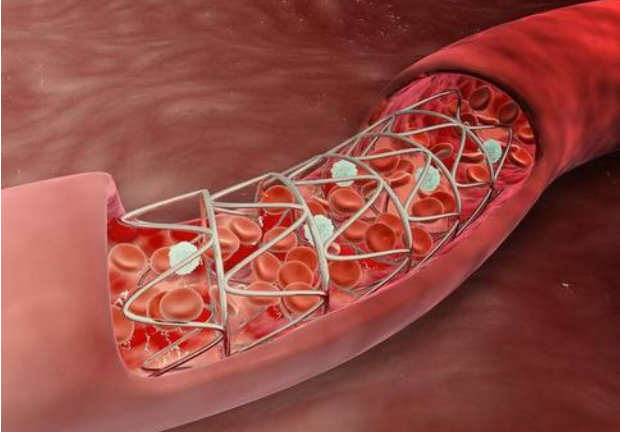 心臟支架又被稱之為冠狀動脈支架,它是一種心臟介入手術中常用的醫療