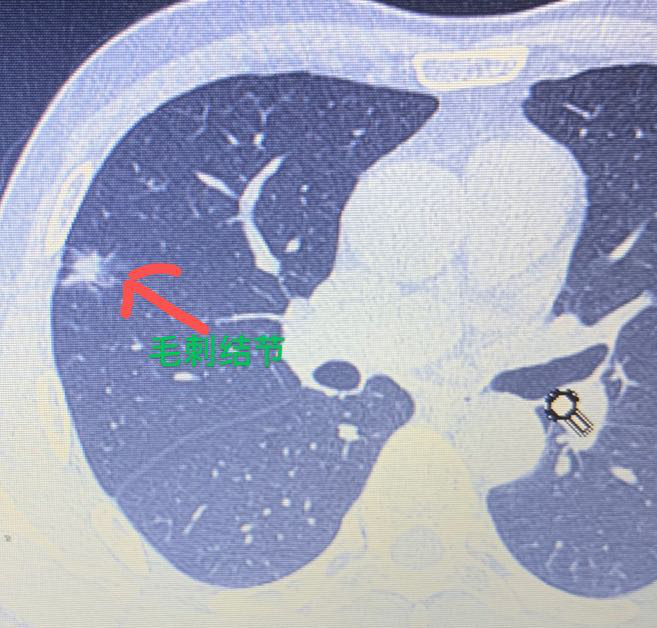 中年男性胸部ct检查发现肺结节有毛刺,还是熊猫血血型,祸不单行