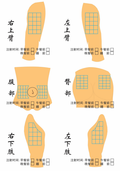 胰岛素部位图轮换图片