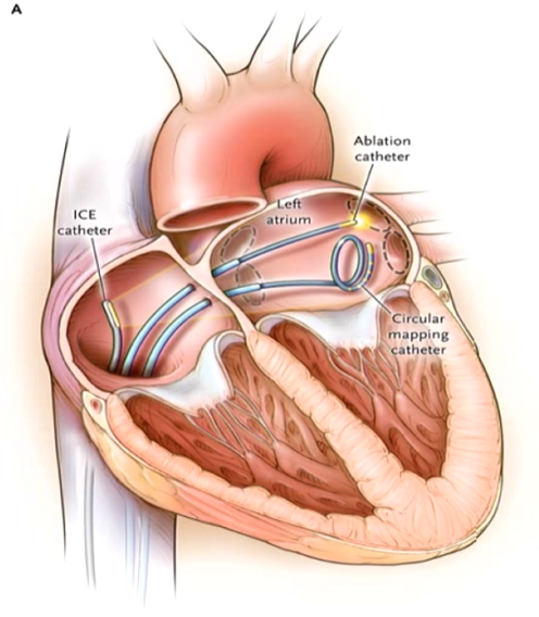 抗凝预防卒中2019 aha/acc/hrs指南指出抗凝适应证为男性cha2ds2