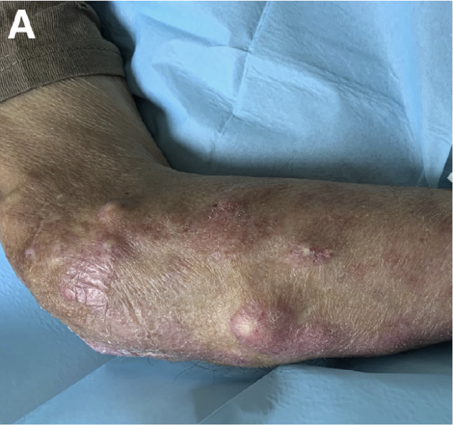 慢性进行性吞咽困难伴特殊皮肤病变这个病须考虑到