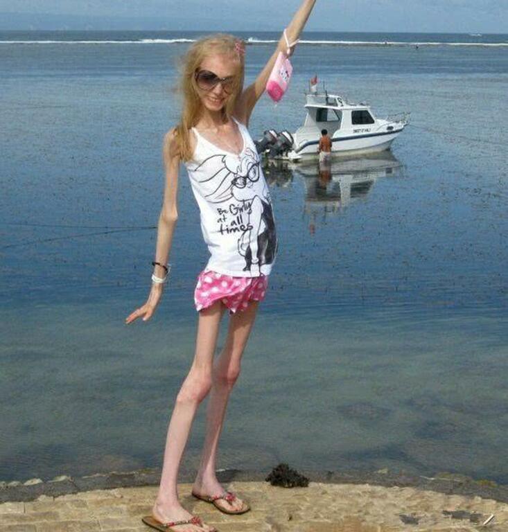 女生为了追求完美身材绝食减肥变活骷髅如今怎样了