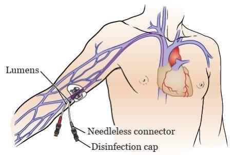 了解了才知道大有好处!|癌症|静脉|穿刺|血管