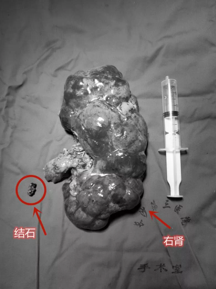 尿管梗阻,不能及时排出的尿液可能引起细菌繁殖,引发肾内感染,肾积脓
