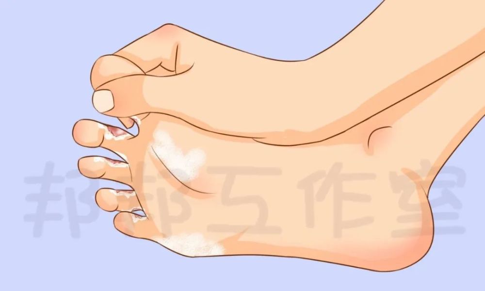 脚趾间糜烂变成 烂脚丫 原来是这个原因 腾讯新闻