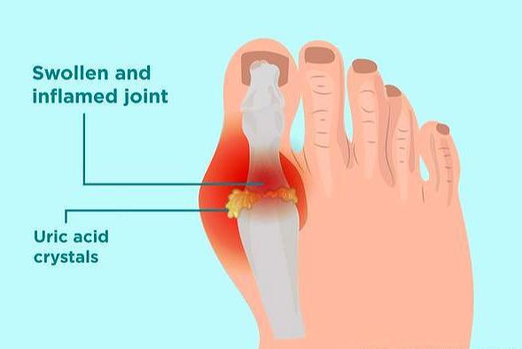 无缘无故脚开始肿痛 多见于这三种疾病 怎么治疗 医生告诉您 腾讯新闻