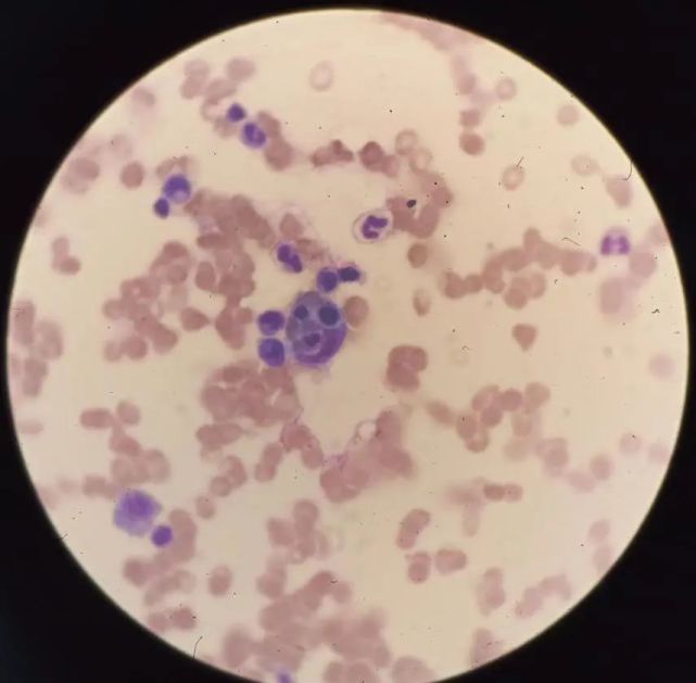 形态立奇功噬血细胞综合征一例