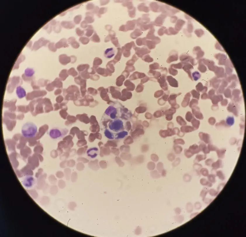 形态立奇功噬血细胞综合征一例