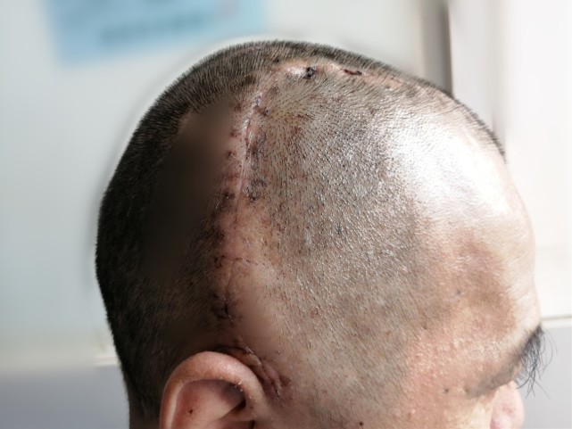 开颅术后不当钢铁侠54岁宁乡男子取下颅骨植入腹部保鲜再回填