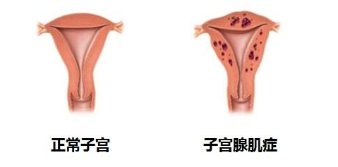 腹痛流血,多半是这四种子宫疾病在作祟!