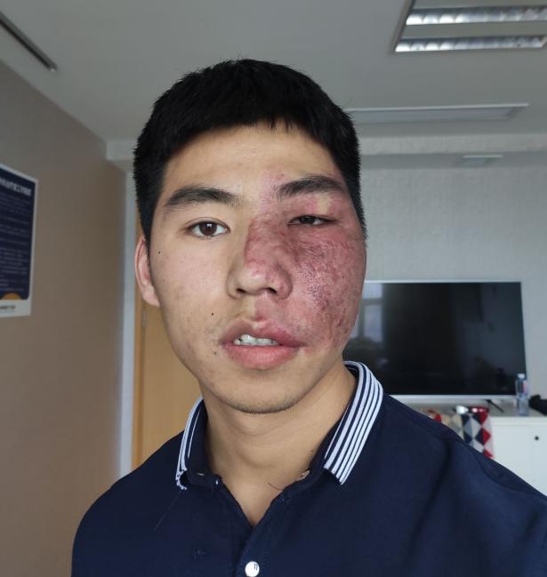 面部鲜红痣触目惊心!小伙为治疗,半年将做3次手术