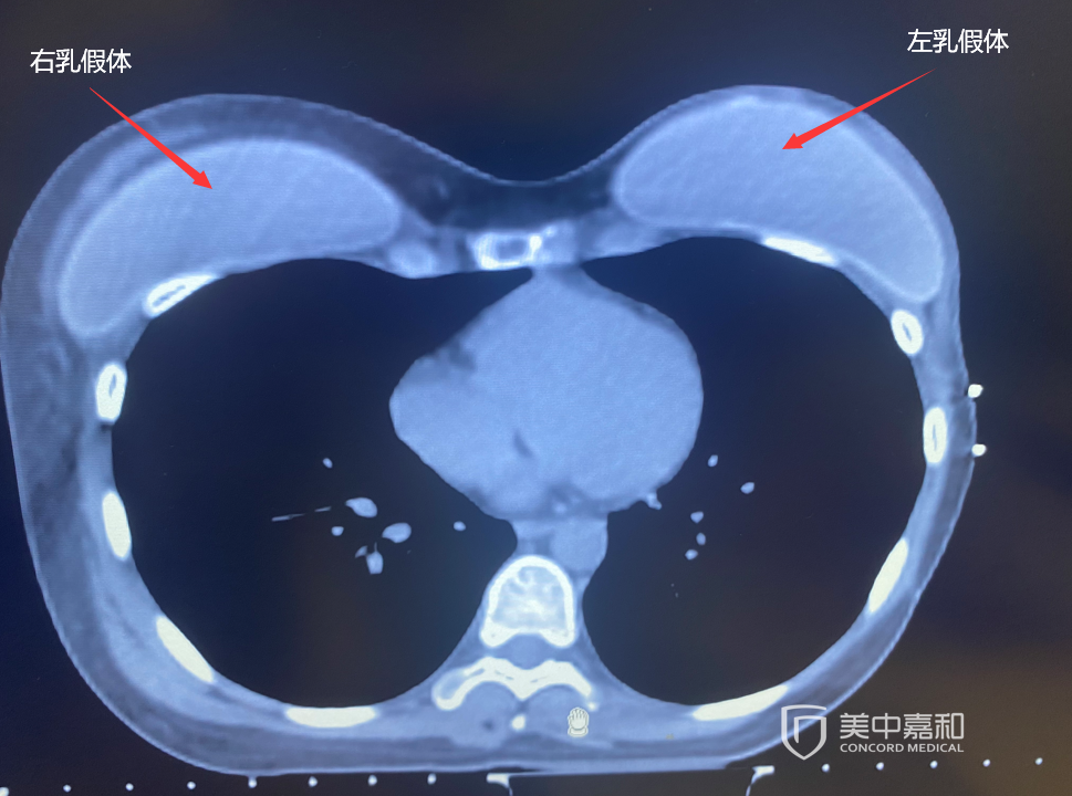 乳腺癌切除后隆胸 如何才能不复发 腾讯新闻