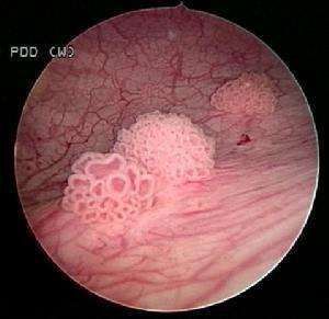 膀胱镜下膀胱癌的表现