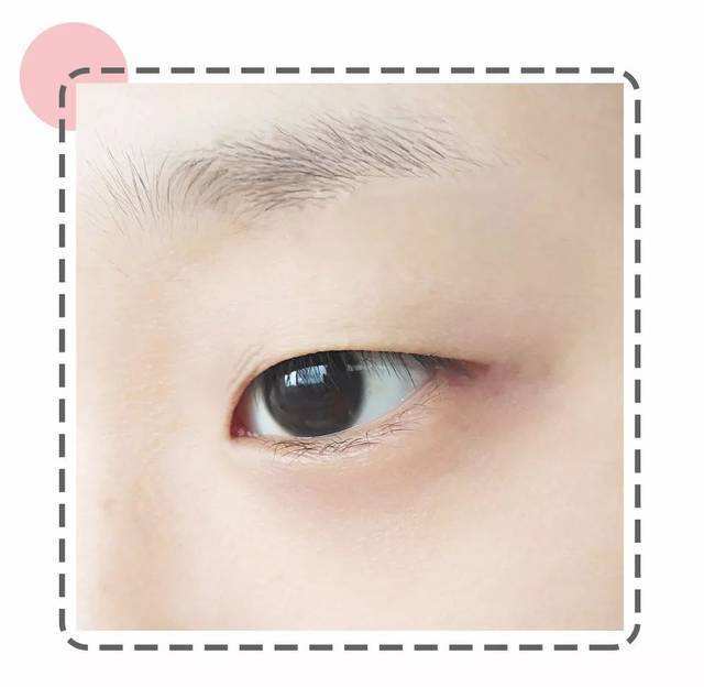 外眼角下垂能否通过双眼皮手术调整 腾讯新闻