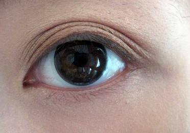 外眼角下垂能否通过双眼皮手术调整 腾讯新闻