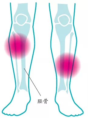 跑步时为什么小腿疼痛可能是伤了胫骨