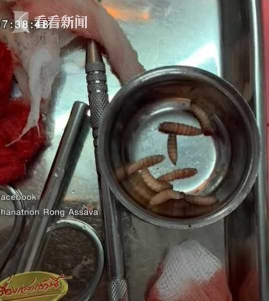 七旬老翁高烧就诊牙龈破洞竟爬出12条白蛆医生吓呆这样解释病因