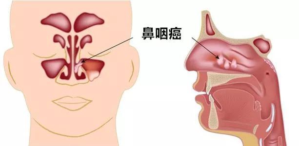 李宗偉患鼻癌兩年後,花936萬治癒:又有幾個癌症患者有936萬?