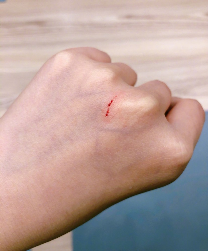 张馨予的手还因为干农活被划破,血都流了出来,而这个伤口还是因为自己