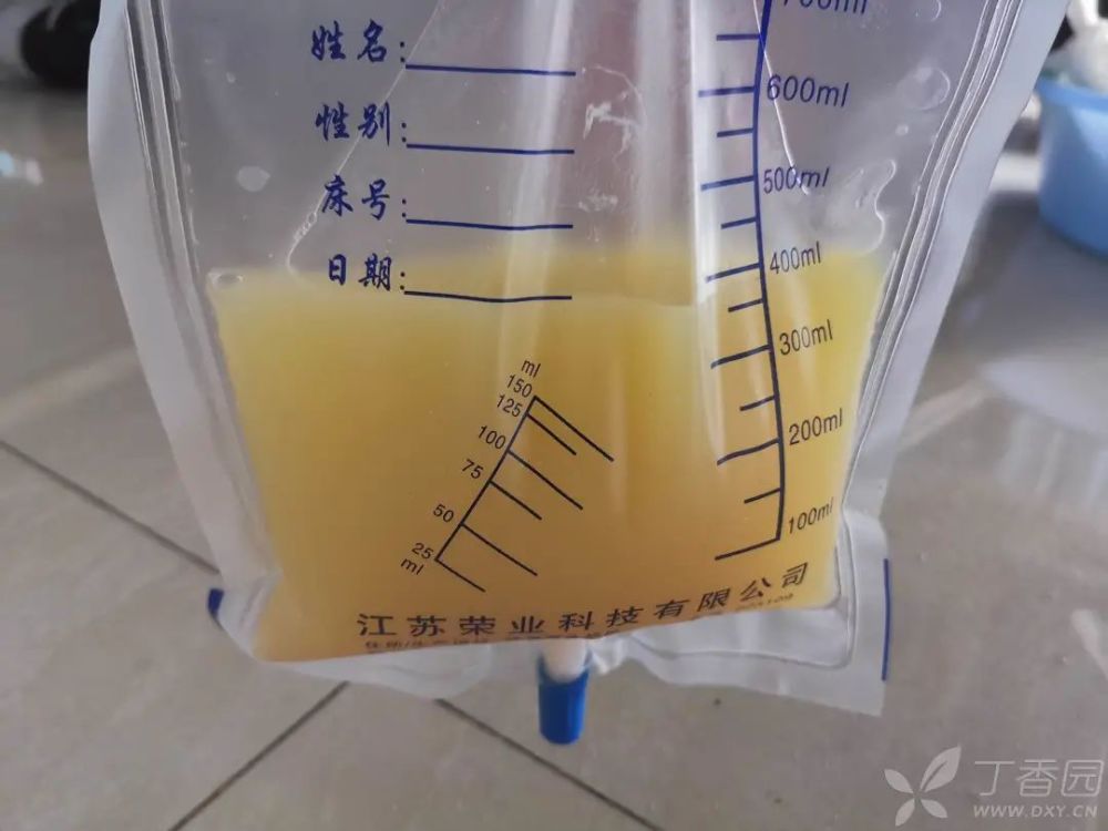 胸部 ct 右肺大片影说明什么? 2