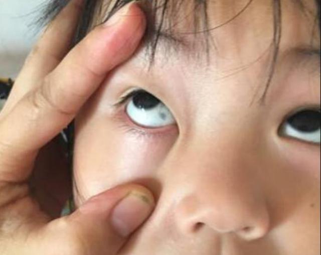 孩子的眼白有"黑点"?多半是这3个原因引起,父母不必太慌张