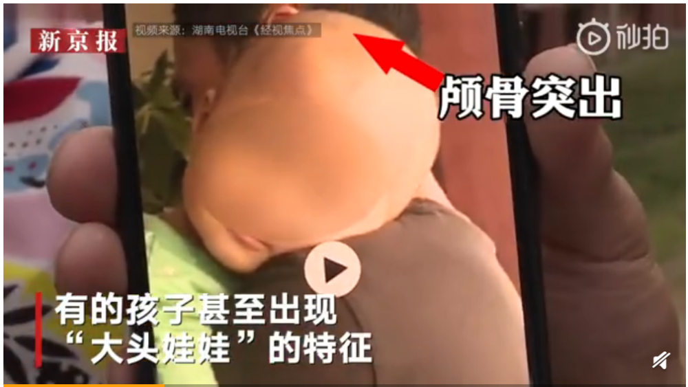 最典型的是骨骼方面的症状,比如这次案例中的方颅.有什么症状?