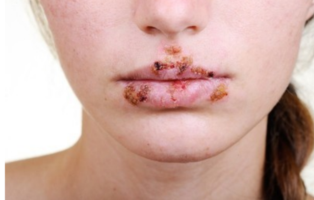 反复口疮,我有妙招!