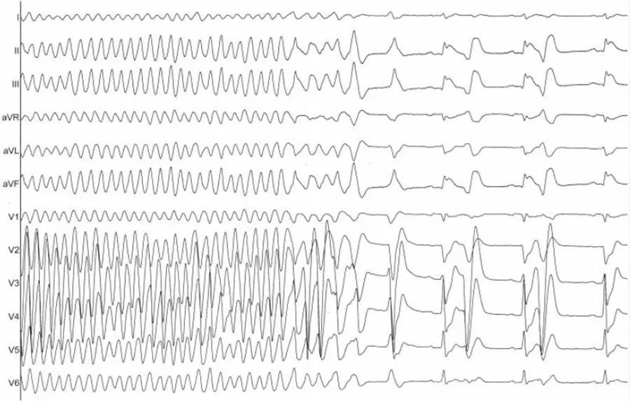 病例丨持续性室颤患者消融终止室颤全过程