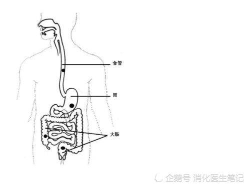 漲知識了,治療腸梗阻,消化內鏡握有這一神器!