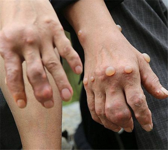 有些人会在关节周围形成很多奇丑无比的痛风石,有的甚至破溃,流脓