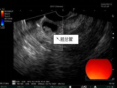 超声胃镜胆管疾病诊断的火眼真金