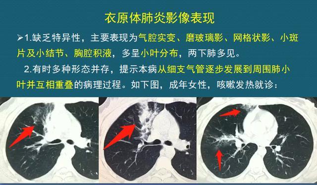 得了鹦鹉热衣原体肺炎,该怎么治疗?