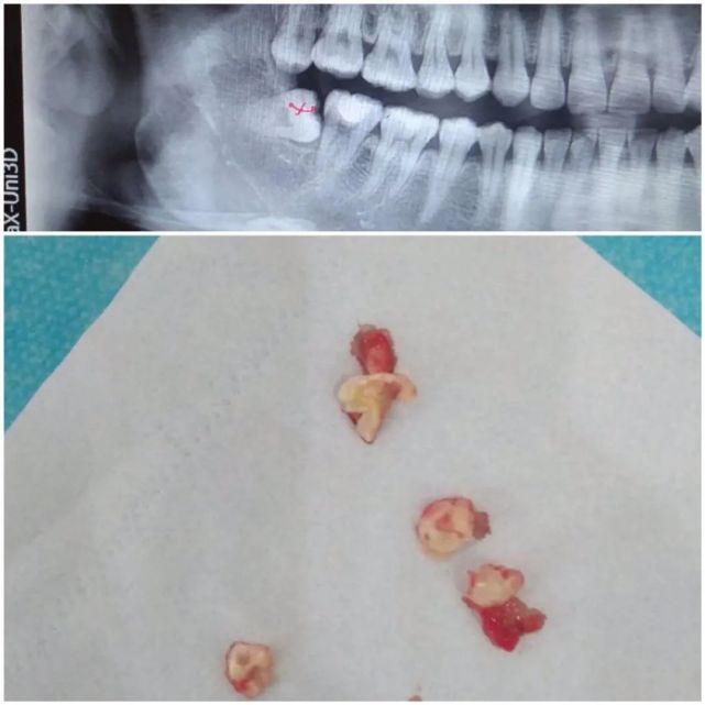 成都拔智齒找他就對了讓你知道什麼是微創拔牙