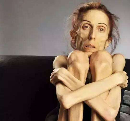 过度减肥小心得了这种要命的病