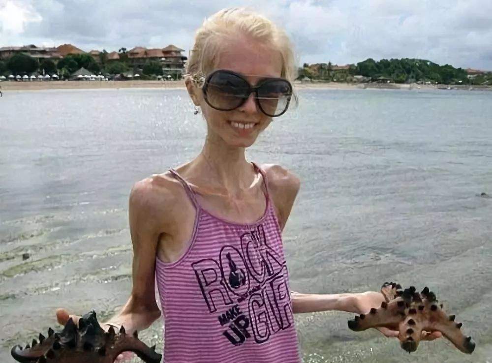 世界上"最瘦"的女人,身高1米58体重仅40斤,堪称行走的骷髅