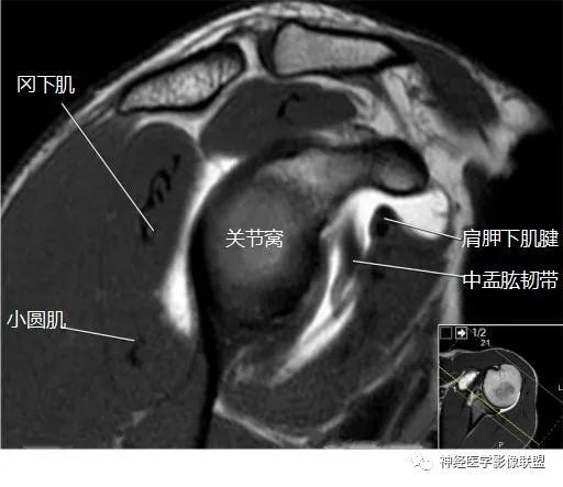 後放大查看mr斷面解剖矢 狀1 拇長屈肌,2 脛骨後肌,3 腓動脈(交通支)