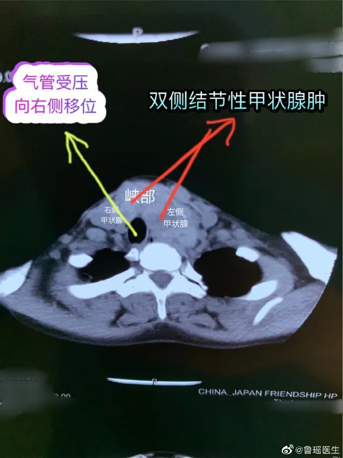甲状腺CT图解图片