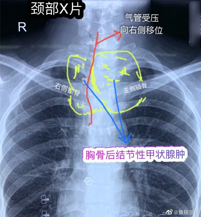 胸骨后是哪个位置图片图片