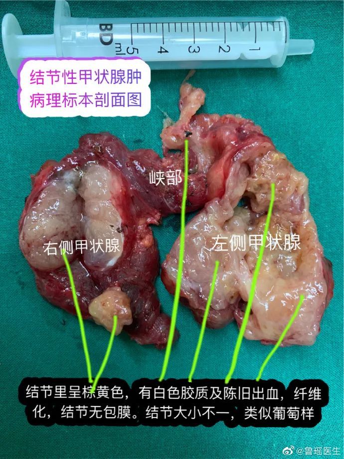 结节性甲状腺肿病理图片