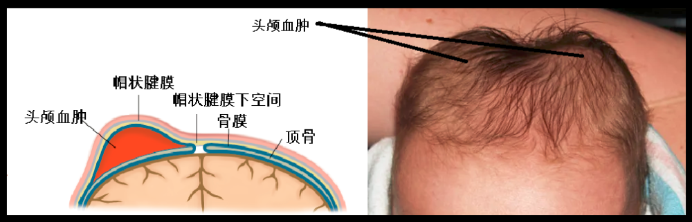 2新生宝宝有头颅血肿需要把血抽出来吗