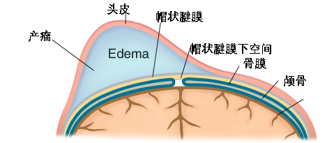 2新生宝宝有头颅血肿需要把血抽出来吗