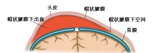 2新生宝宝有头颅血肿需要把血抽出来吗