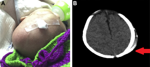 2新生宝宝有头颅血肿需要把血抽出来吗