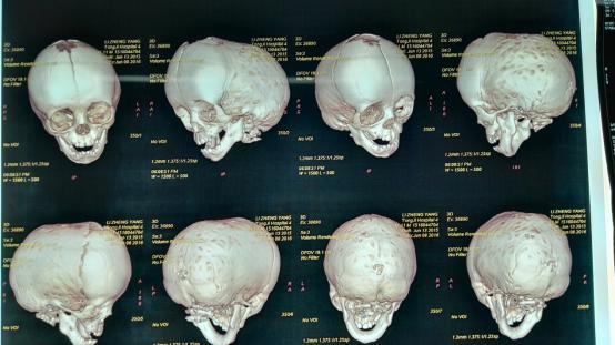 孩子的头大,头小,偏头,方颅,是什么原因?一次性弄清楚!