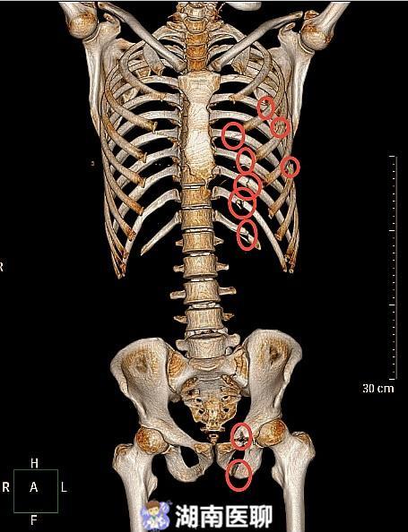 十二根肋骨图片