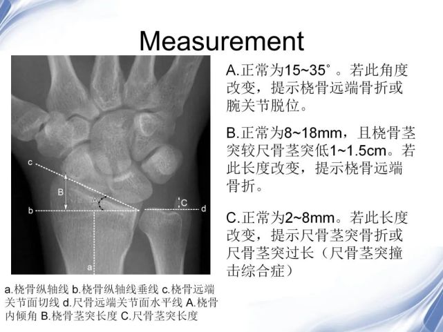 【每日學術】腕關節-x線解剖圖解