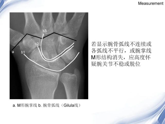 【每日學術】腕關節-x線解剖圖解