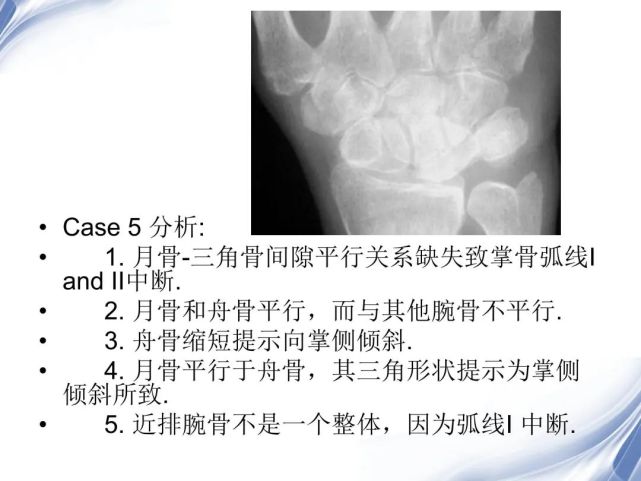 【每日學術】腕關節-x線解剖圖解